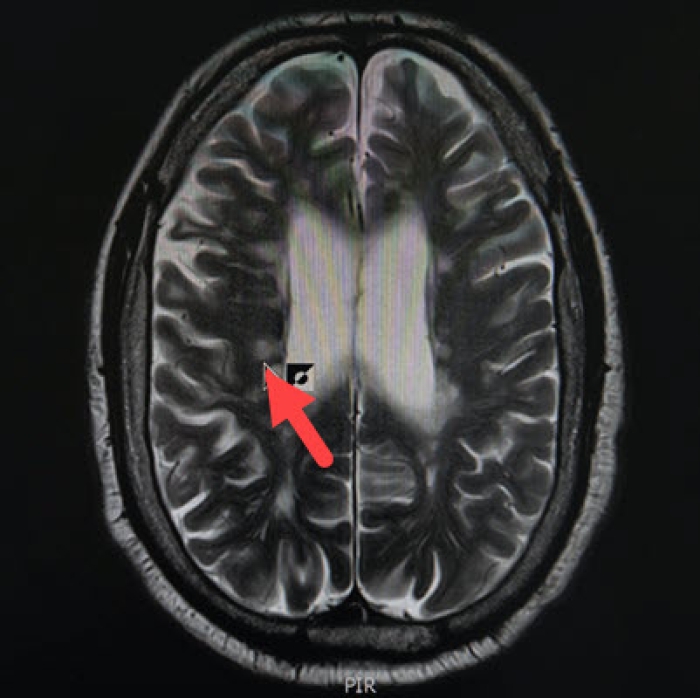Bij de pijl op deze hersenscan is een afwijking van de witte stof (myeline) te zien, wat duidt op multiple sclerose.