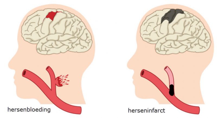 Er kan bij een beroerte sprake zijn van twee problemen in de hersenen: een hersenbloeding of herseninfarct. 